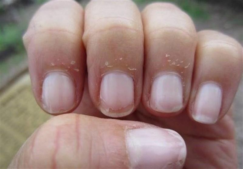 درمان سنتی برای ریش ریش شدن کنار ناخن ها