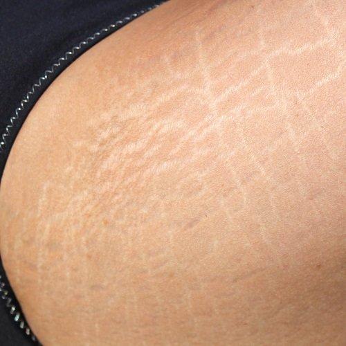 بیماری سلولیت نوعی خود ایمنی است