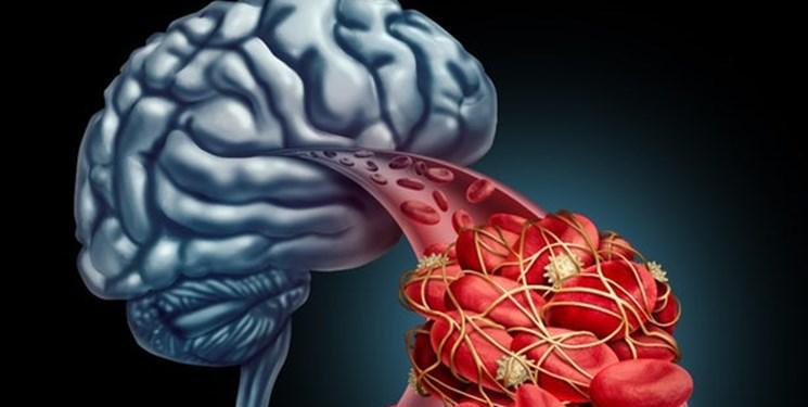 کشف انسداد عروق خونی مغز، راهی را برای درمان آلزایمر