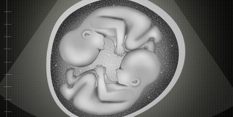 دوقلوهای نیمه همسان؛ یک اتفاق نادر در دنیا