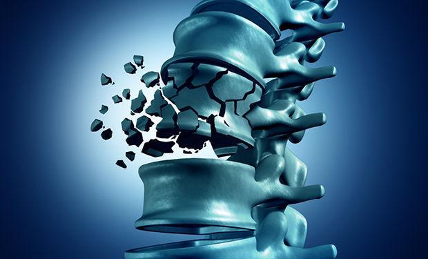 پوکی استخوان؛ بیماری پنهانی که راه رفتن را برایتان سخت می کند