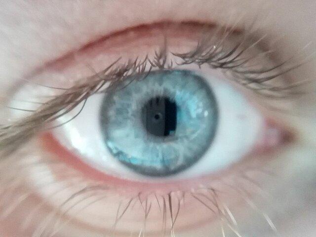 نشانه های پارکینسون در چشم ها