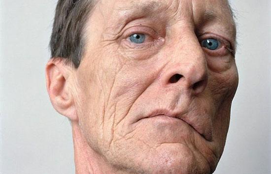 فلج بل چیست و چه علائمی دارد؟