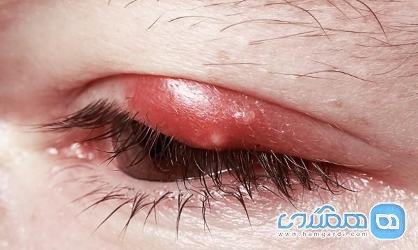 خطراتی که گل مژه چشم برای شما دارد