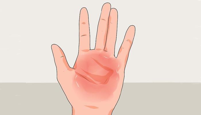 راه های درمان سوختگی با آب جوش؛ بایدها و نبایدها