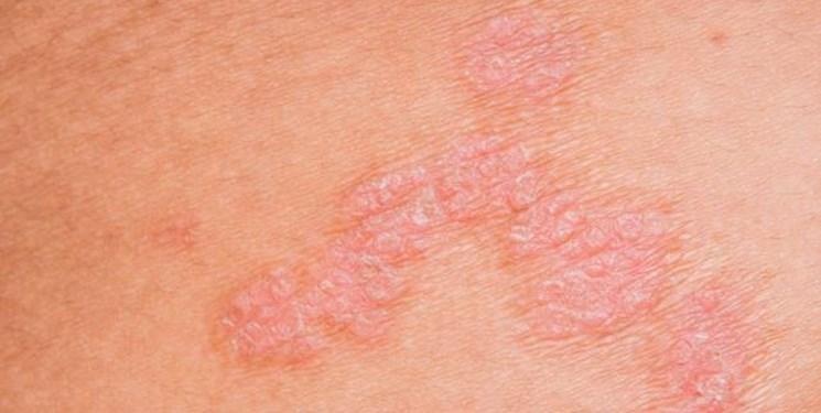 ابزارهای پزشکی ایران ساخت به یاری ضایعه های پوستی آمدند