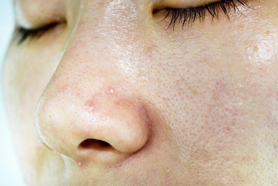 نکته بهداشتی: کنترل پوست چرب نکته بهداشتی: کنترل پوست چرب