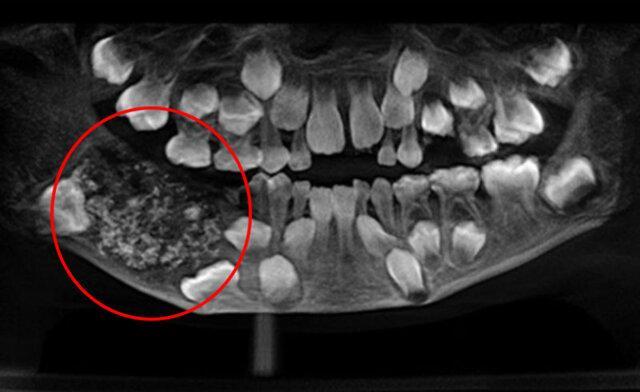 کشف 526 دندان در دهان پسربچه هندی