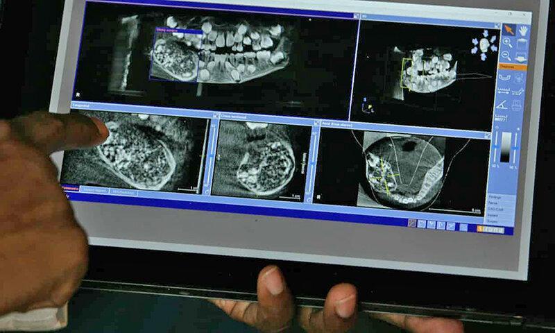 21+526 دندان در دهان پسرک هفت ساله هندی