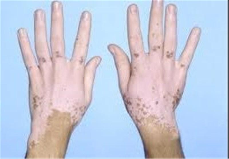 ابداع ترکیبی جدید برای درمان ضایعات پوستی توسط محققان کشور