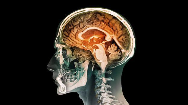 بدون یک نیمکره مغز به صورت عادی زندگی کنیم!