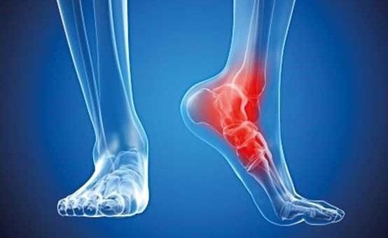 چه کسانی بیشتر دچار خار پاشنه می شوند؟