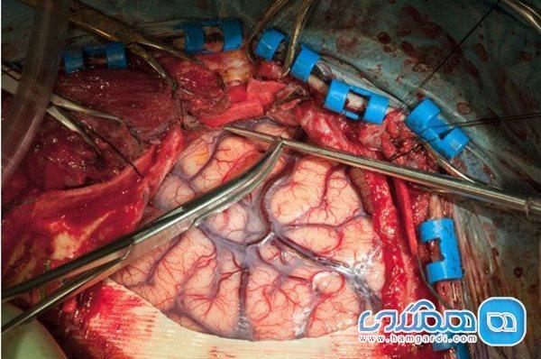 بهترین زمان برای درمان سکته مغزی حاد
