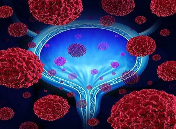 اهمیت خودآزمایی بالینی در تشخیص سرطان سینه