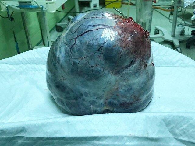 خارج کردن توده شش کیلویی از شکم زن 47 ساله اردبیلی