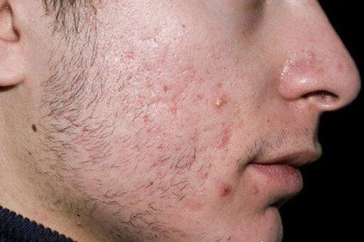 نکته بهداشتی: آکنه نوجوانان ، مراقبت های اولیه