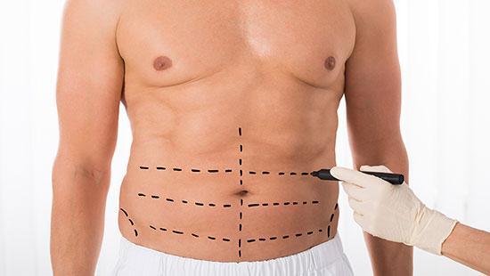 لیپوماتیک یا پیکرتراشی؛ مزایا و عوارض و هزینه