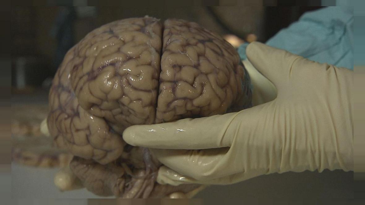 محققان با مادون قرمز نمای درونی مغز را دیدند ، تحقق رویای درمان سرطان های مغزی