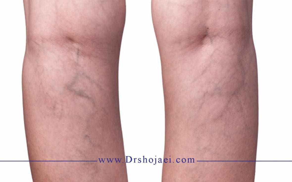 واریس و درمان واریس
