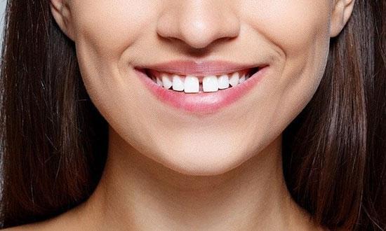با دندان های فاصله دار چه کار کنیم؟ با دندان های فاصله دار چه کار کنیم؟