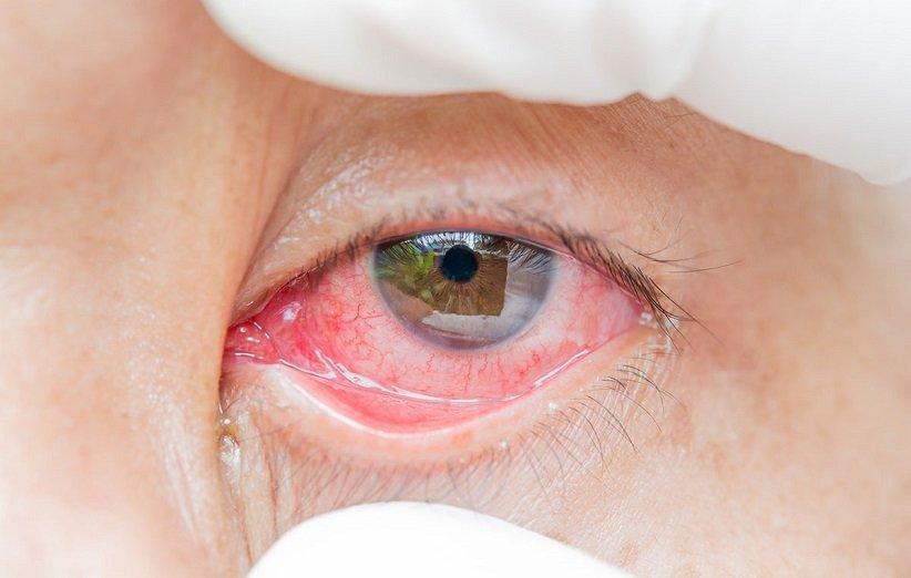 قرمزی چشم، علت و راهکار چیست؟