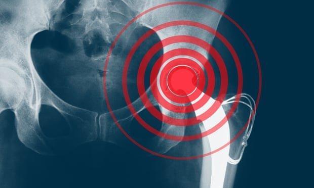 3 توصیه کلیدی درباره پوکی استخوان