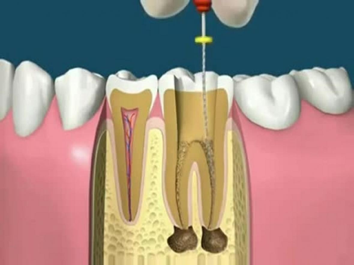 چه زمانی دندان ها به درمان کانال ریشه نیاز دارند؟