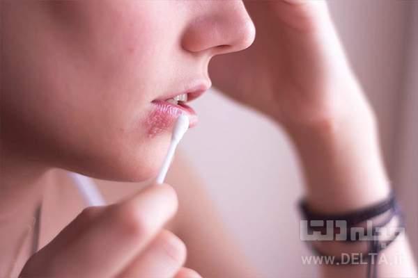 5 روش درمان خانگی تبخال