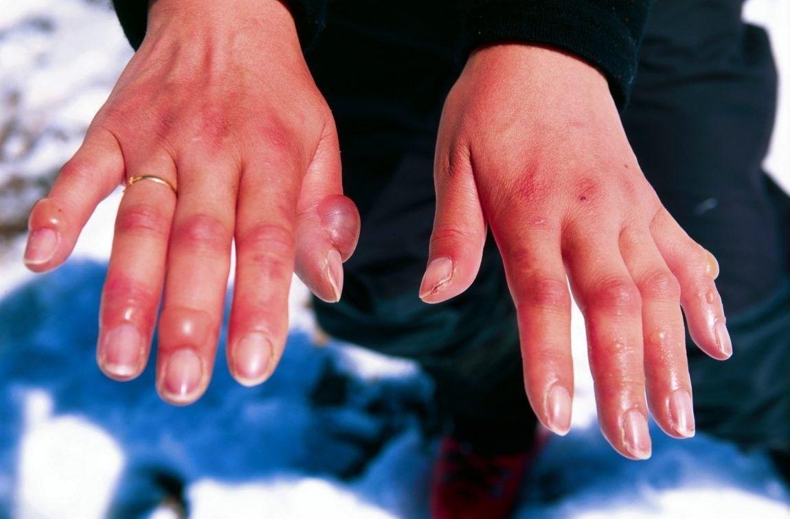 در مواجهه با فرد سرمازده چه باید کرد؟