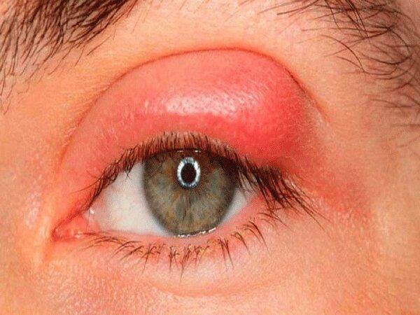 وقتی شوره های چشم دیدتان را تیره و تار می کند وقتی شوره های چشم دیدتان را تیره و تار می کند