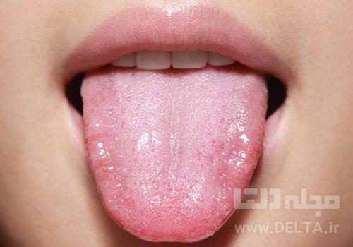چرا زبان سفید می شود؟ چرا زبان سفید می گردد؟