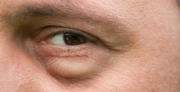 5 دلیل خستگی و پف چشم ها پس از بیدار شدن از یک خواب خوب شبانه