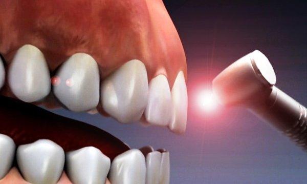 تشخیص به موقع حفره های دندانی با فناوری مادون قرمز تشخیص به موقع حفره های دندانی با فناوری مادون قرمز