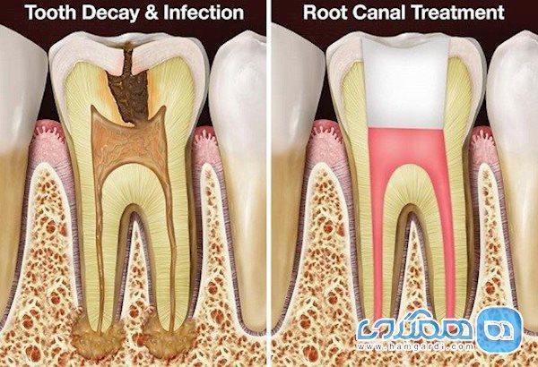 عمر دندان عصب کشی شده چه قدراست؟