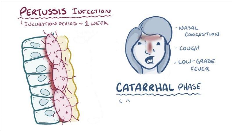 سیاه سرفه چیست و چه علائم و نشانه هایی دارد؟ شیوه های تشخیص و درمان آن کدامند؟