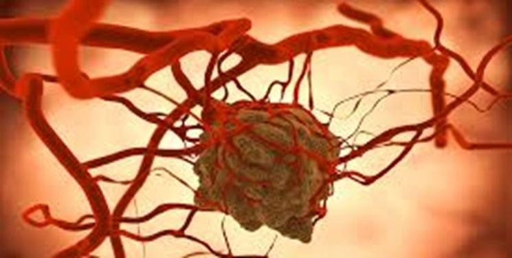 راهی که ابتلا به سرطان سینه را کاهش می دهد