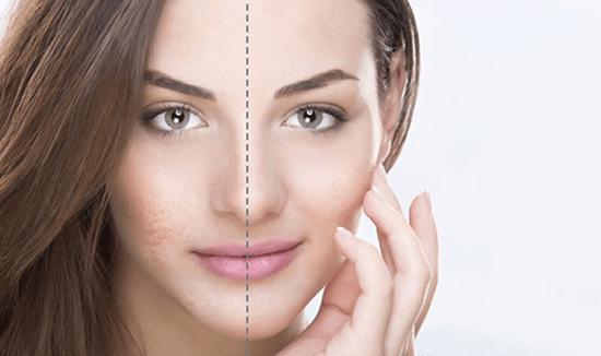 سابسیژن چیست و چگونه انجام می گردد؟