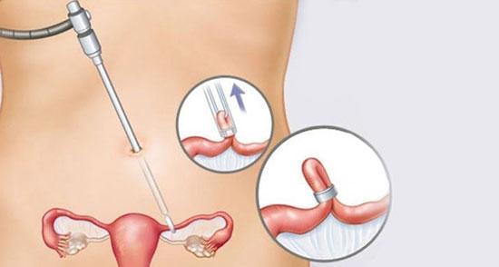 توبکتومی یا بستن لوله های رحم چیست و چگونه انجام می گردد؟