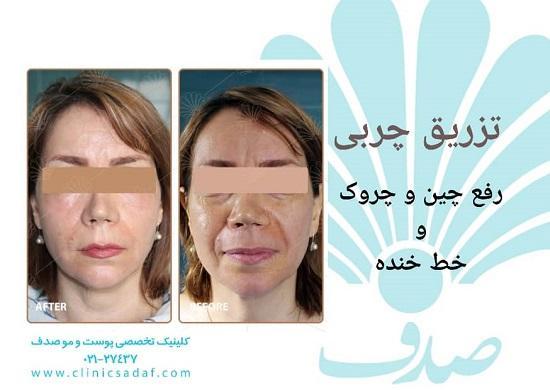 تزریق چربی به صورت و هزینه آن تزریق چربی به صورت و هزینه آن