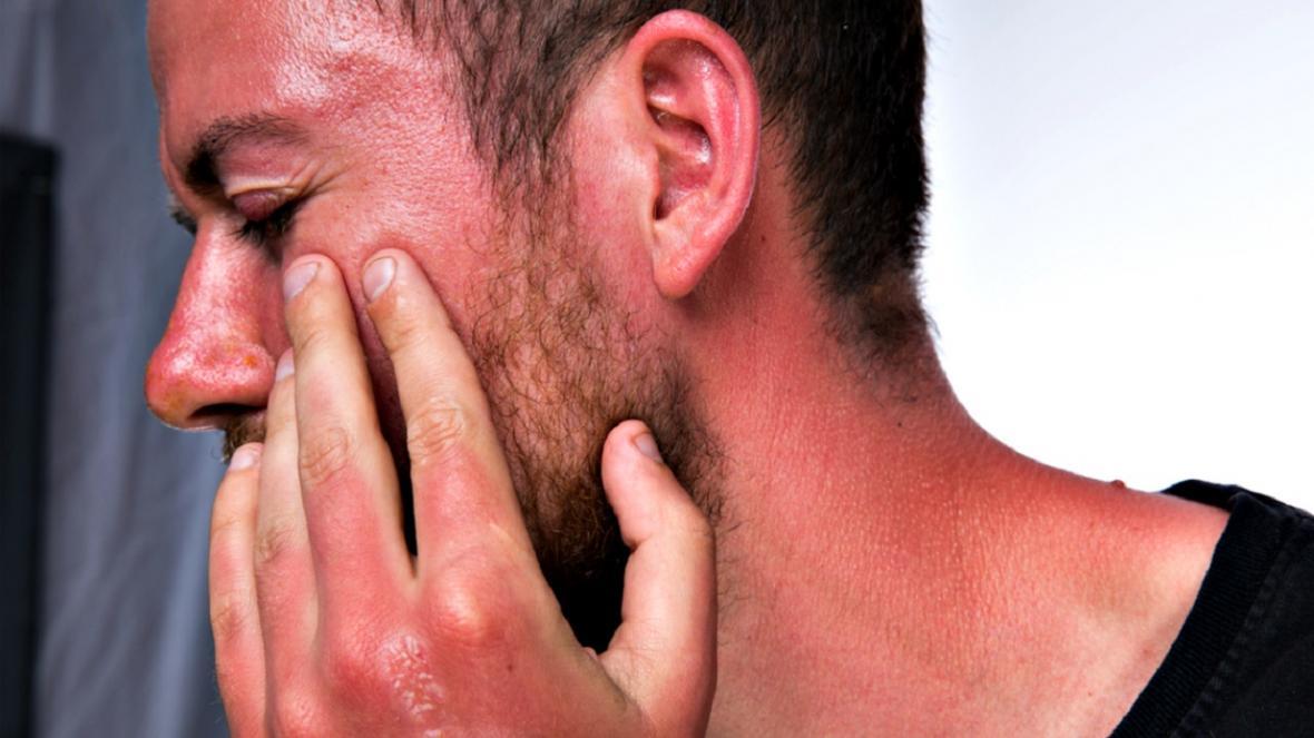 آفتاب سوختگی؛ خطرناک تر از آن چه فکر می کنید