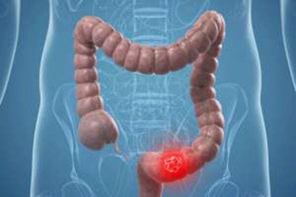 تاثیر چراغ معابر و خیابان ها بر خطر ابتلا به سرطان روده عظیم