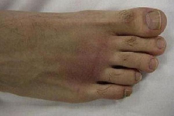 شیوع بیماری نقرس در دنیا رو به افزایش است