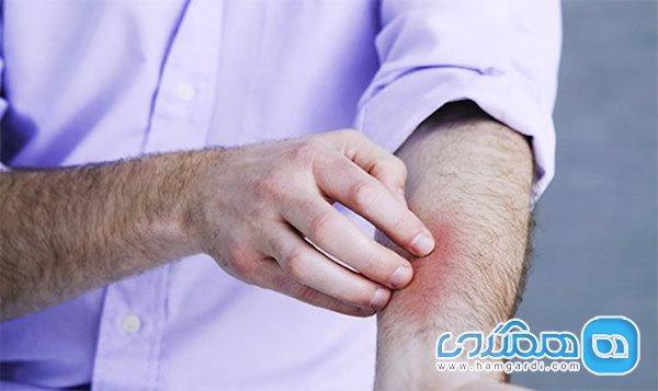 آیا استرس می تواند باعث بروز کهیر گردد؟