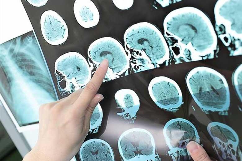 مقابله با آسیب های مغزی و نخاعی با استفاده از آنزیم طبیعی