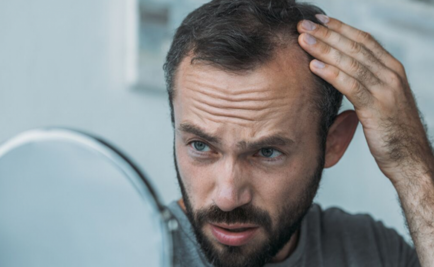 کاشت مو طبیعی، از ریزش تا کاشت مو