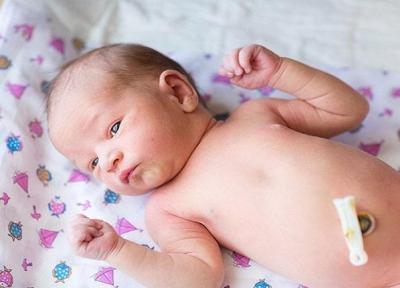 در افتادن بند ناف نوزاد، چه مواردی را مدنظر قرار دهیم؟