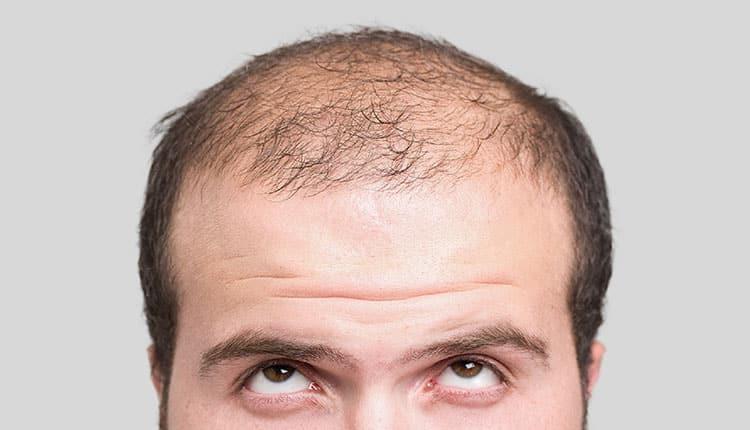 بهترین فصل کاشت مو چیست و هر فصلی چه مزایا و معایبی برای بهترین فصل کاشت مو چیست و هر فصلی چه مزایا و معایبی برای کاشت دارد؟
