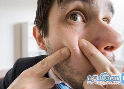 چرا جوش می زنیم و چگونه درمانش کنیم؟