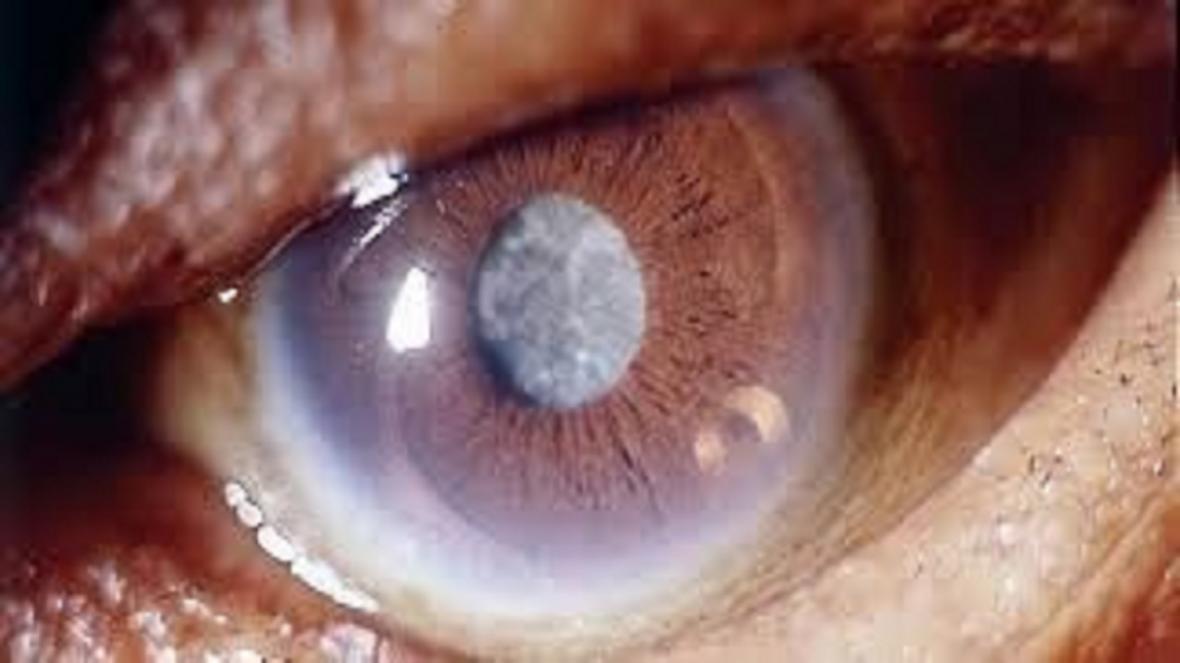 بیماری آب مروارید از دلایل و علائم تا درمان آن