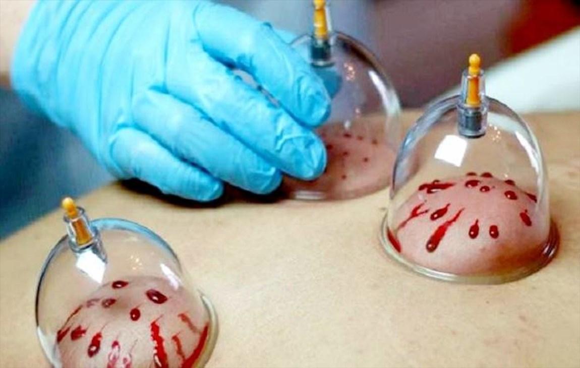 توصیه های جدی در خصوص حجامت در بین افراد مسن